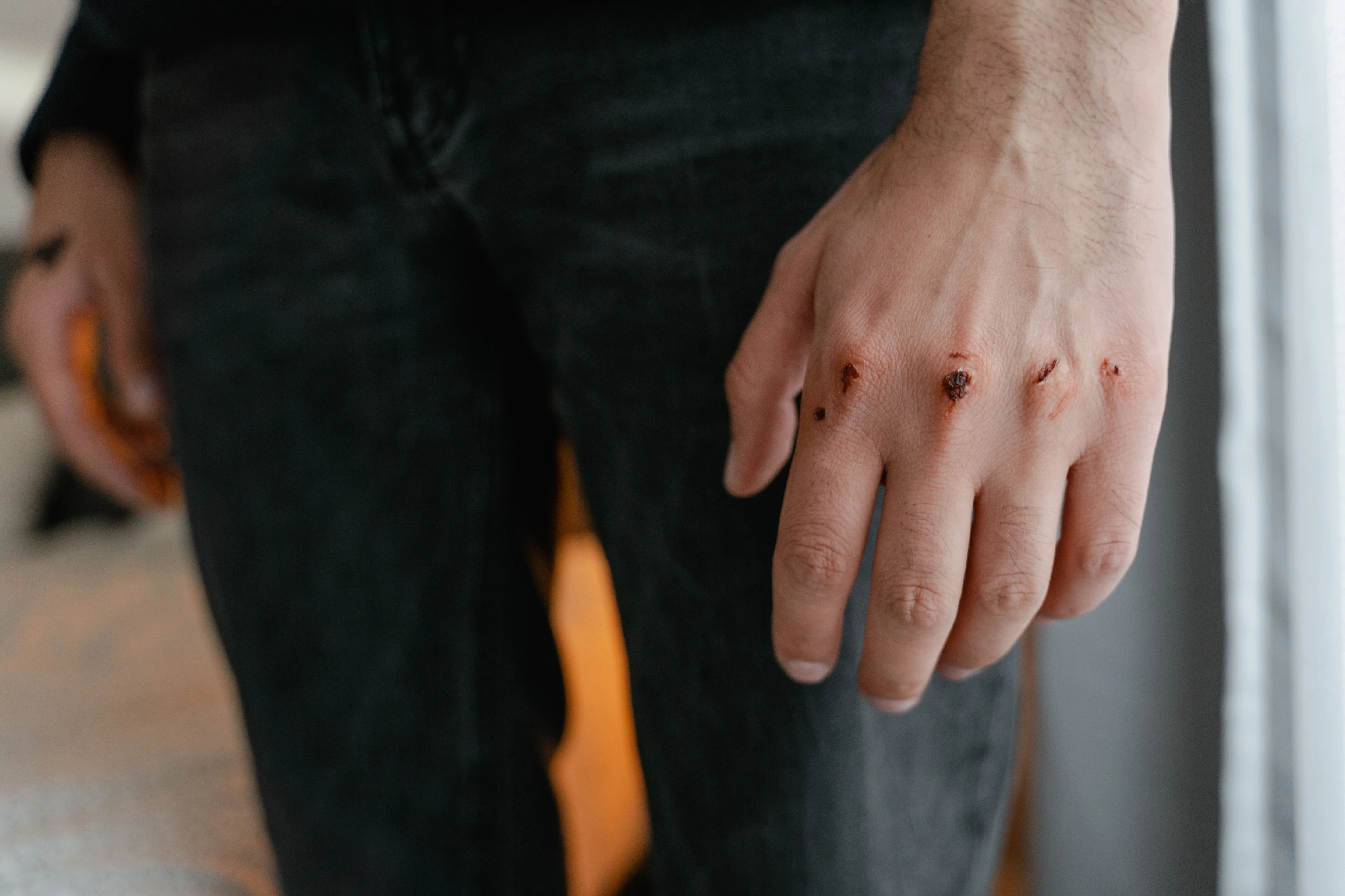 do mice bite Detailed image of a hand with visible wounds and scratches, emphasizing injury.