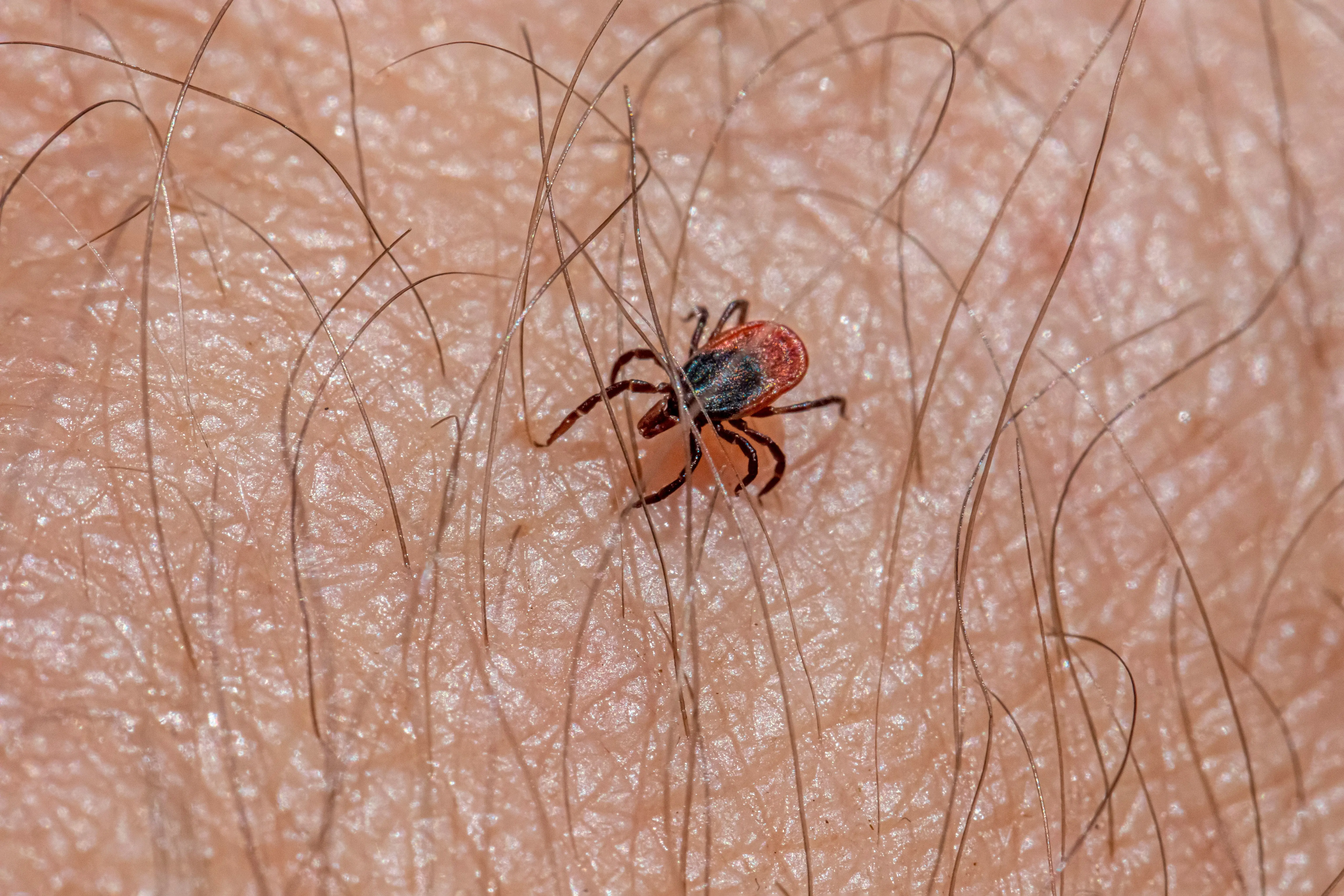 spider bite vs mosquito Macro view of a castor bean tick on human skin, highlighting tick's details.